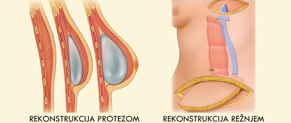 Rekonstrukcija dojke