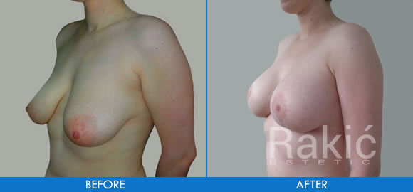 Breast reduction and breast lift