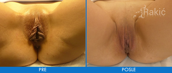 Labioplastika Pre i Posle operacije