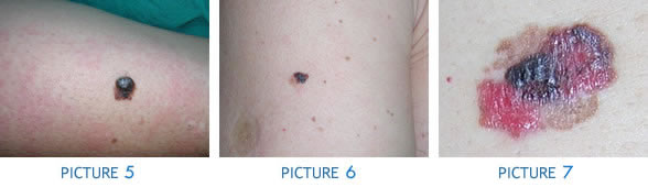 Malignant skin tumors