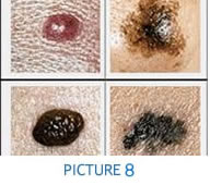 Malignant skin tumors