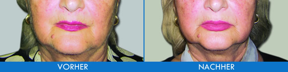 Vergrösserung - lippenmodellierung Vergrösserung - lippenmodellierung