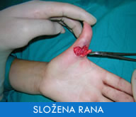 Slozena rana